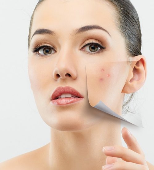 acne-image