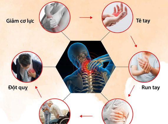 Tác hại của đau vai gáy gây ra bạn nên biết