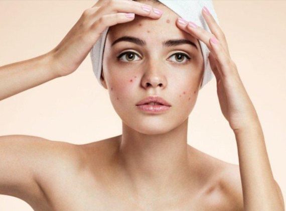 Nguyên nhân gây mụn đến từ những thói quen thường ngày.