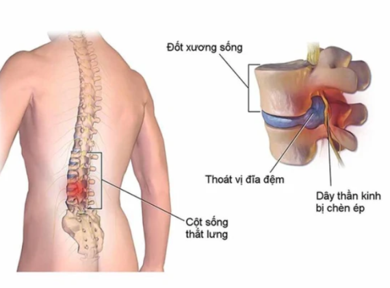 đau thắt lưng