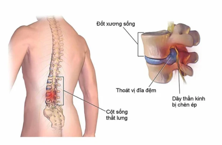 Nguyên Nhân Và Triệu Chứng Đau Mỏi Vùng Thắt Lưng