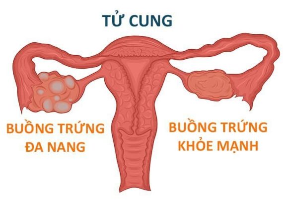 Những phương pháp nào để chăm sóc và bảo vệ tử cung buồng trứng.