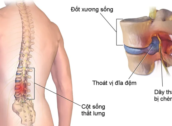 Thoát vị đĩa đệm là gì và tại sao người ngồi nhiều dễ mắc phải?