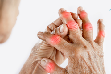 Cứng khớp, hạn chế vận động