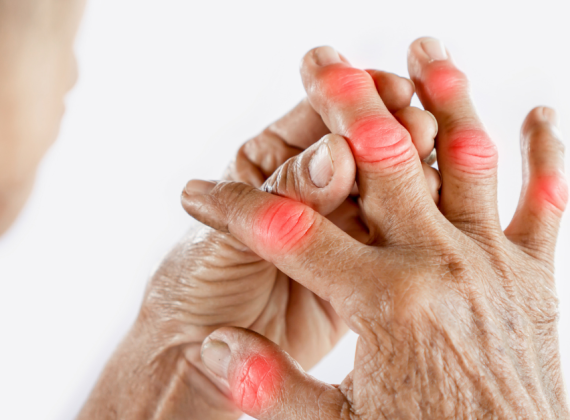 Cứng khớp, hạn chế vận động